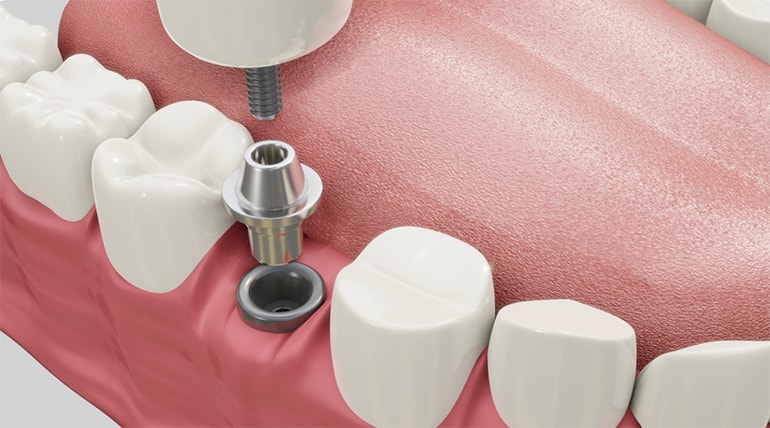 Traditionelle Implantation